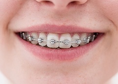 Closeup of smile with metal braces