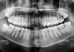 Digital dental x-rays on computer